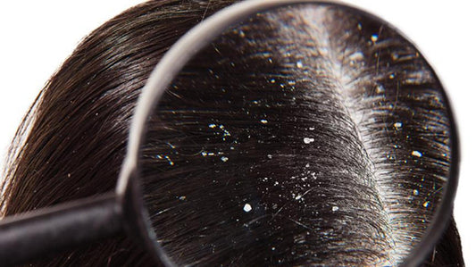 The Ultimate Guide to Caring for Dry Hair & Scalp Naturally